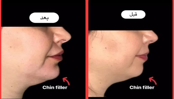 نمونه اصلاح پروفایل صورت با تزریق چانه دکتر مریم کشاورز