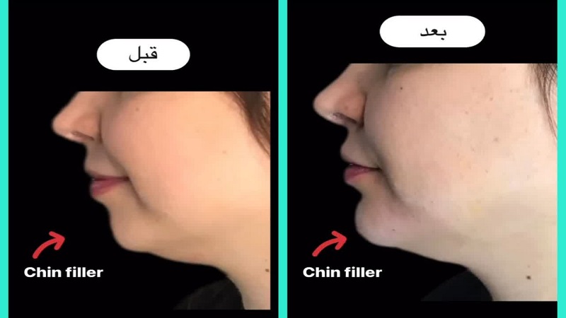 اصلاح پروفایل صورت با تزریق چانه | پزشک زیبایی اصفهان | دکتر مریم کشاورز