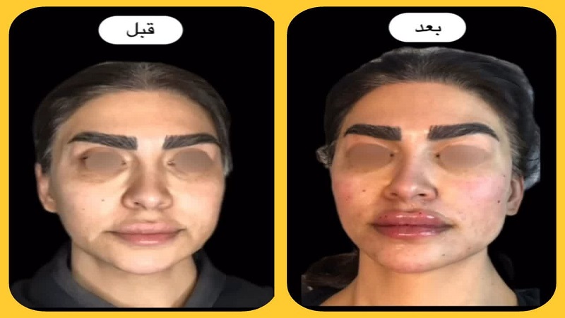 نمونه کانتورینگ و مدلینگ صورت توسط دکتر مریم کشاورز